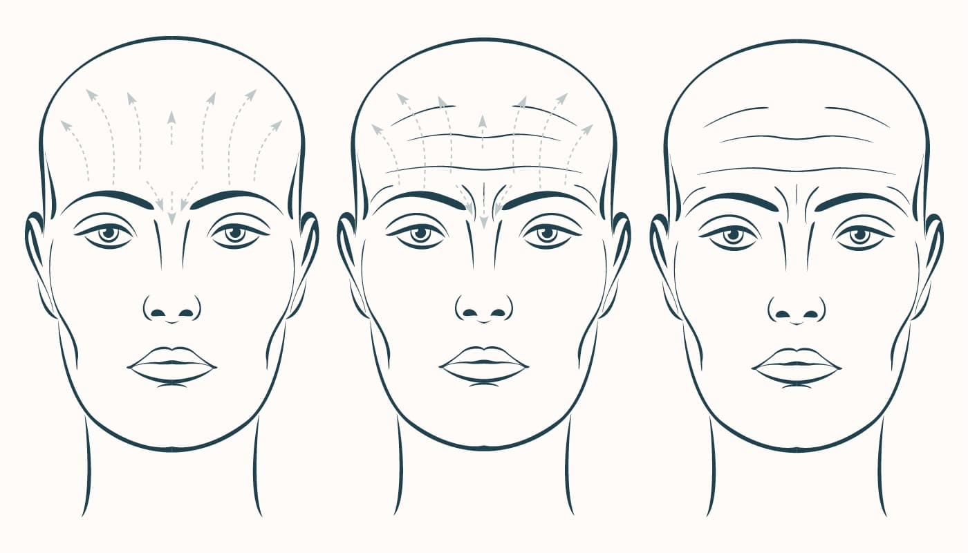 Botox Treatment In Lehi Utah Smart Skin Dermatology